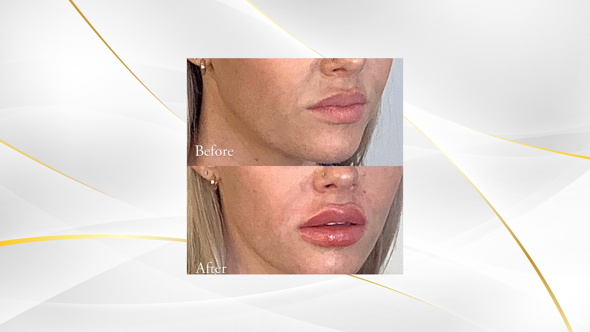Dermal filler long lasting Diamond Aesthetics